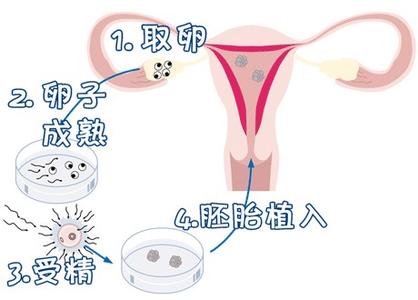 反复流产案例